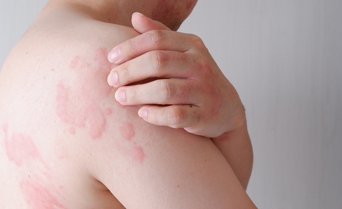 Man scratching itchy hives on his body