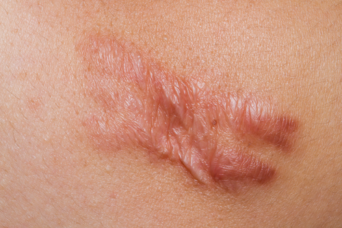 Skin showing raised keloid formations as a result of scar tissue overgrowth.