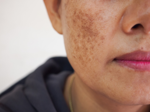 Close-up of a woman's face showing melasma patches