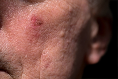 Close-up of skin showing actinic keratosis caused by prolonged sun exposure